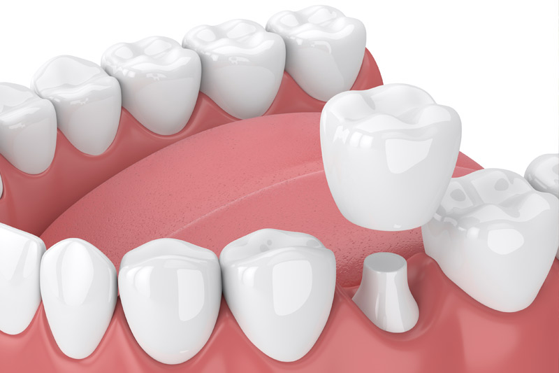 Dental Crowns in Thousand Oaks