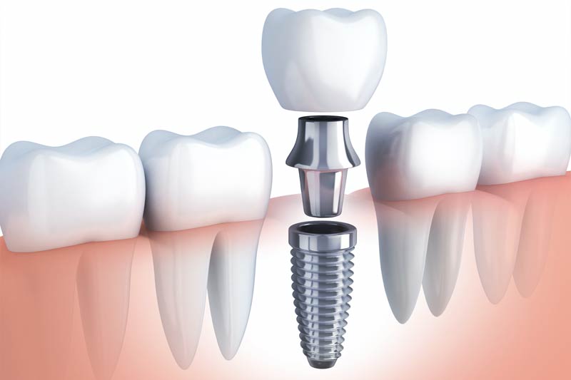 Implants Dentist in Thousand Oaks