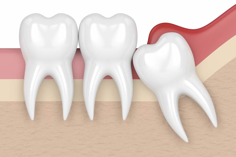 Wisdom Tooth Removal in Thousand Oaks